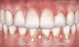 Tooth Wear.